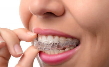 Invisalign aligners